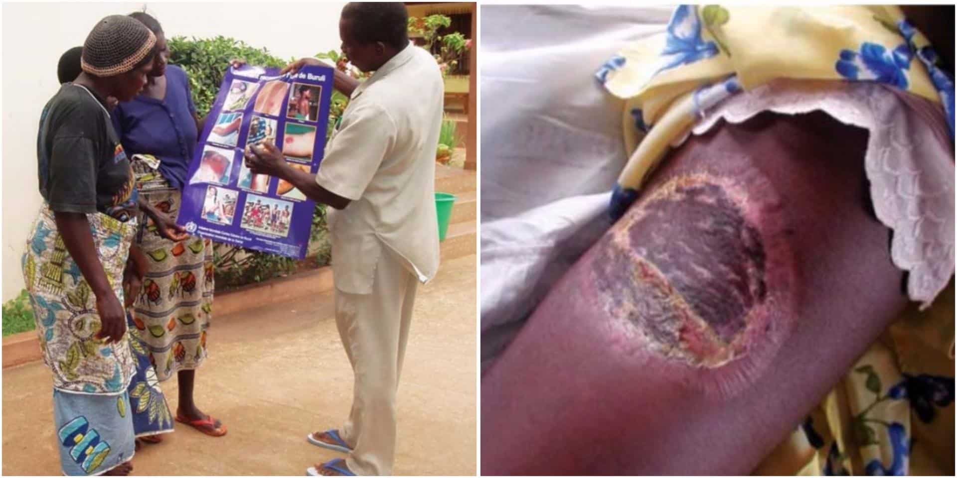 Lutte contre l'Ulcère de Buruli au Bénin : des consultations gratuites démarrent le 12 mai 2025