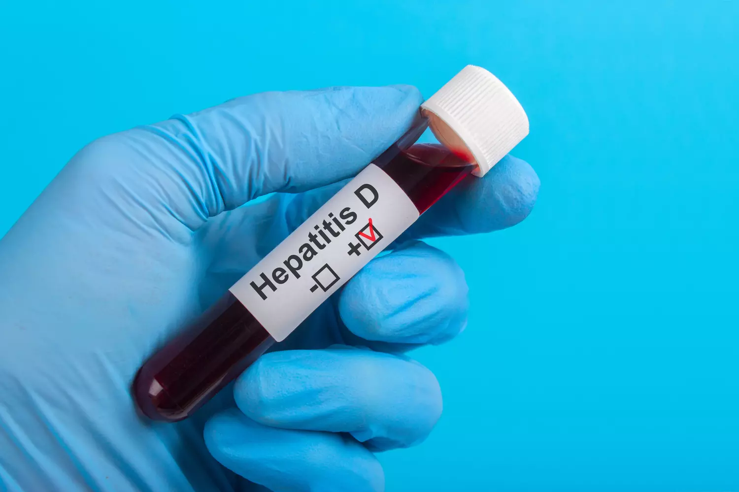 Hépatite : le type D désormais classé comme cancérogène, selon l’OMS