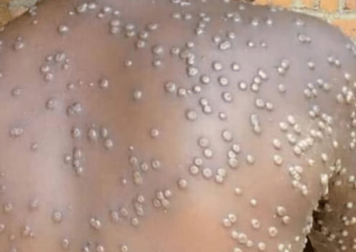 Mpox en RDC : forte recrudescence des cas dans le Haut-Katanga, les autorités sanitaires en alerte